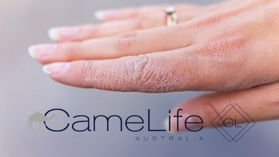 Image of dry skin treated by camel milk skincare