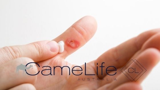 Image of a burnt finger treating with camel milk skincare